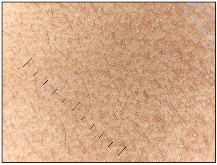 ‘Dot in circle’ sign (zygoma).