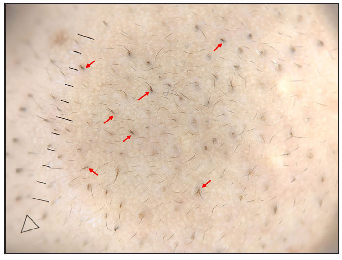 Trichostasis spinulosa (red arrows) seen as tufts of vellus hair from a follicular opening (nose) (Heine delta 30, 10x, polarised).