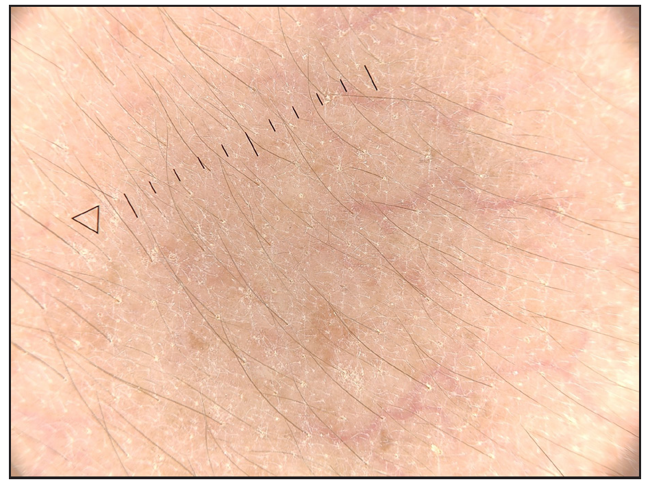 Unfocussed linear branching vessels on cheek (Heine delta 30, 10x, polarised).