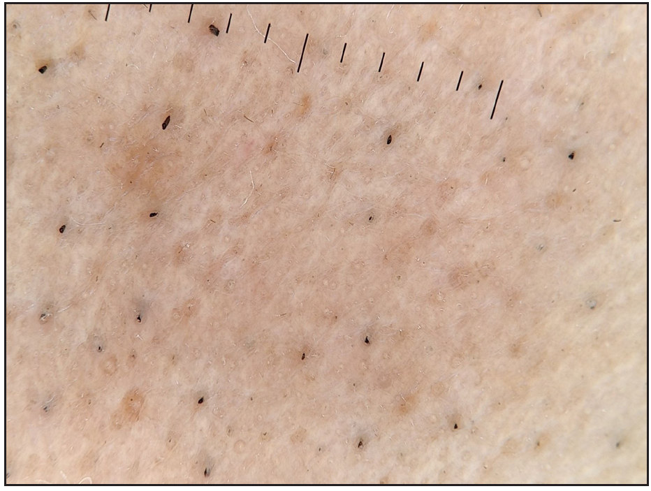 White reticular lines on nose (Heine delta 30, 10x, polarised).