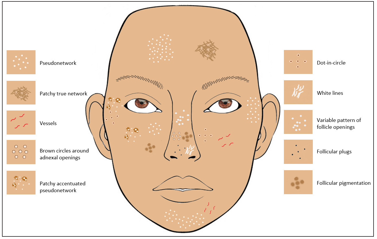 Schematic representation of the site-specific dermoscopic variations of the normal face.