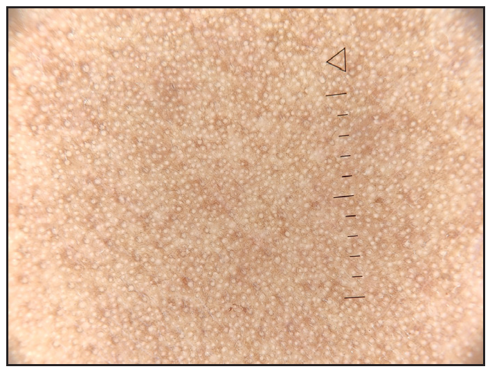 Background uniform pseudonetwork, in-focus, with uniform size and distance of follicle openings (forehead) (Heine delta 30, 10x, polarised).