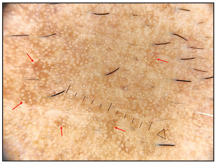 Patchy accentuation of pseudonetwork (solar lentigo-like, red arrows) and background pseudonetwork (cheek) (Heine delta 30, 10x, polarised).