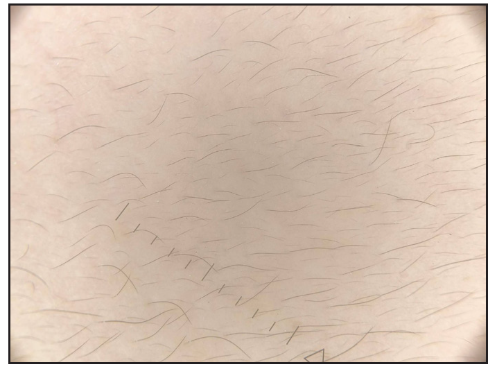 Absent pseudonetwork (cheek) (Heine delta 30, 10x, polarised).