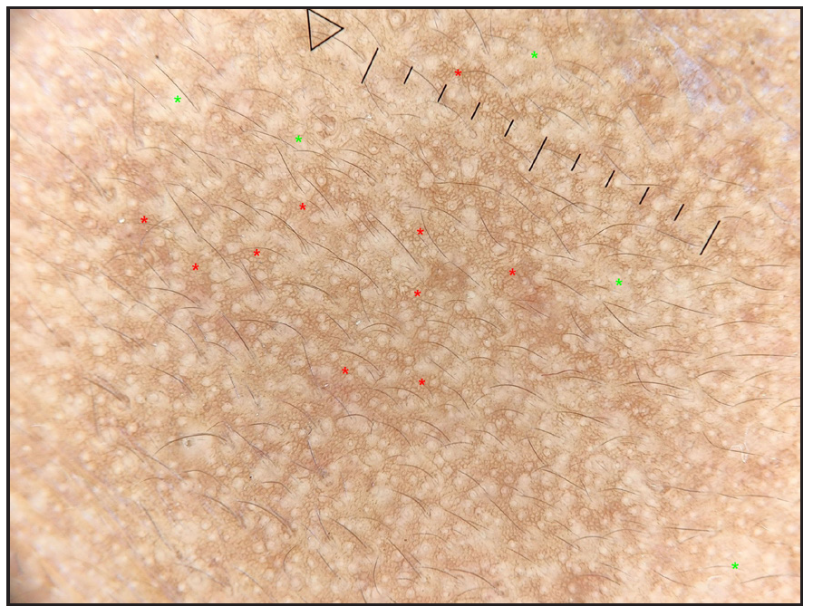 True network (red *) and background pseudonetwork (green *) (forehead) (Heine delta 30, 10x, polarised).
