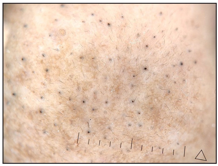 Follicular plugs (nose) (Heine delta 30, 10x, polarised).