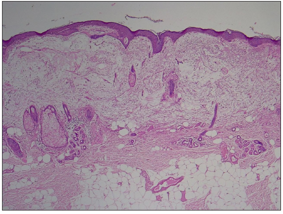 Unremarkable epidermis and a loose myxomatous tumour in the dermis (Haematoxylin and eosin, 40x).