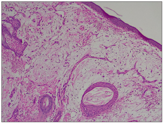 Lobulated myxoid mass with thin-walled blood vessels (Haematoxylin and eosin, 100x).