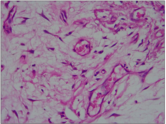 Stellate fibroblasts surrounded by pools of mucin and dilated blood vessels (Haematoxylin and eosin, 400x).