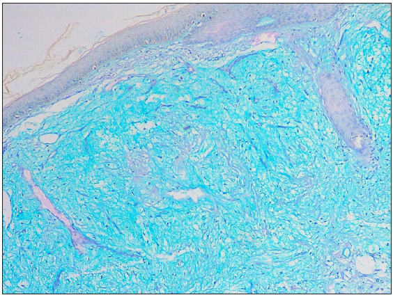 Alcian blue and PAS stain 100x highlights mucin in the dermis.