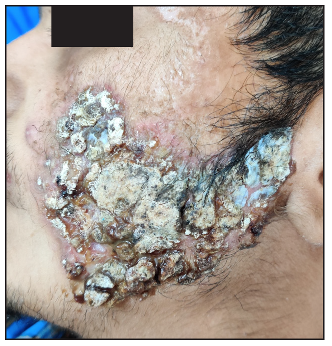 Erythematous plaque over the left cheek with areas of yellow-black crusting and scarring.