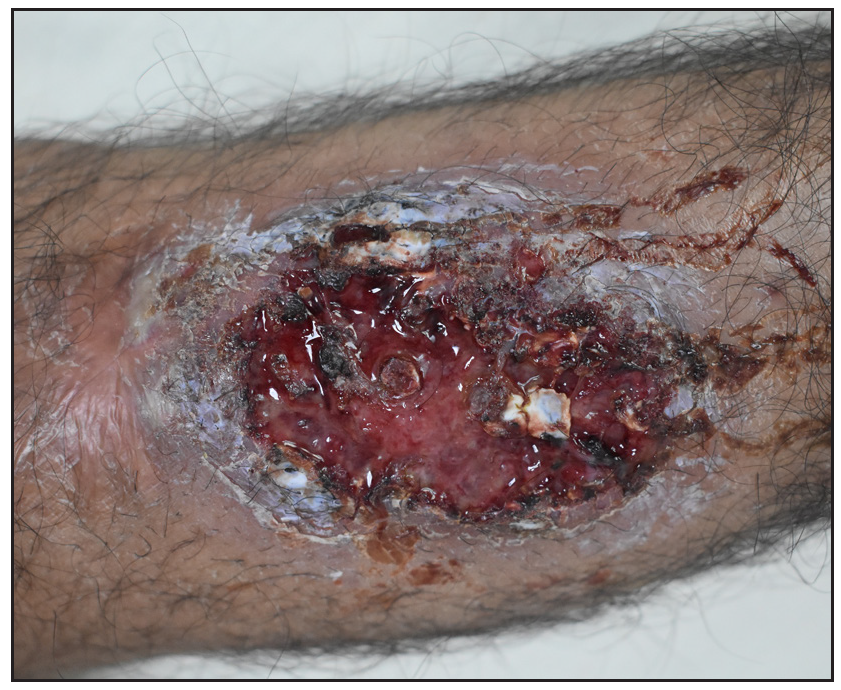 An ulcer over the right leg with haemorrhagic crust and serosanguinous discharge. Surrounding peripheral skin showed violaceous discoloration.