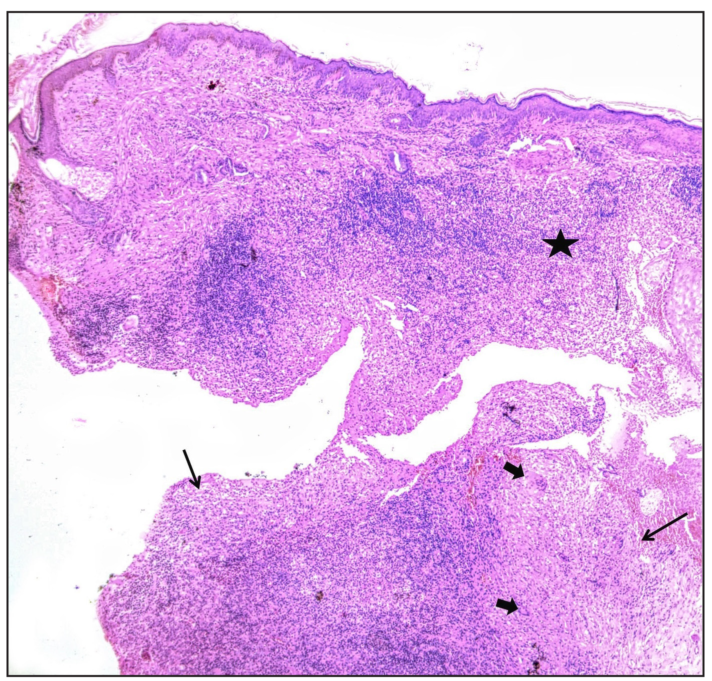 Biopsy from face showing intense mixed inflammation in superficial dermis (asterisk) and deep dermal granulomas (black arrows) with giant cells (block arrows) (Haematoxylin & eosin, 50x.)