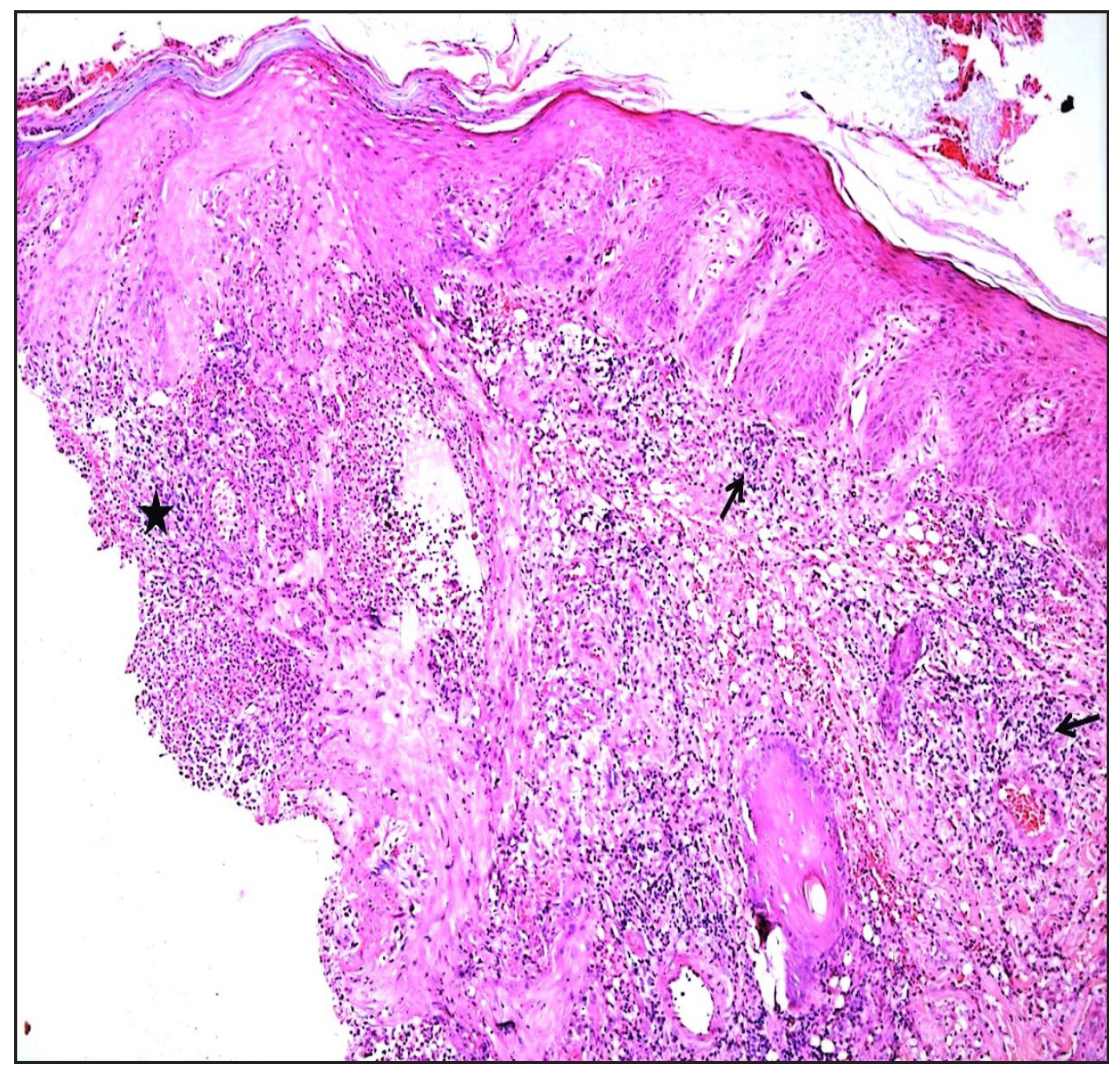 Biopsy from leg plaque showing ulcer edge (asterisk) and lymphocytic vasculitis with infiltrate around dermal vessels (black arrows) (Haematoxylin & eosin, 200x).