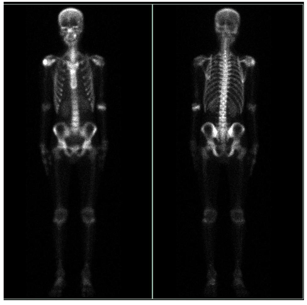 99mTc MDP (Methyl Diphosphonate) bone scan anterior and posterior images showing increased radiotracer uptake in bilateral shoulders (right> left), left elbow, bilateral knee and bilateral ankle joint. The right clavicle appears expanded with a mild increase in tracer uptake.