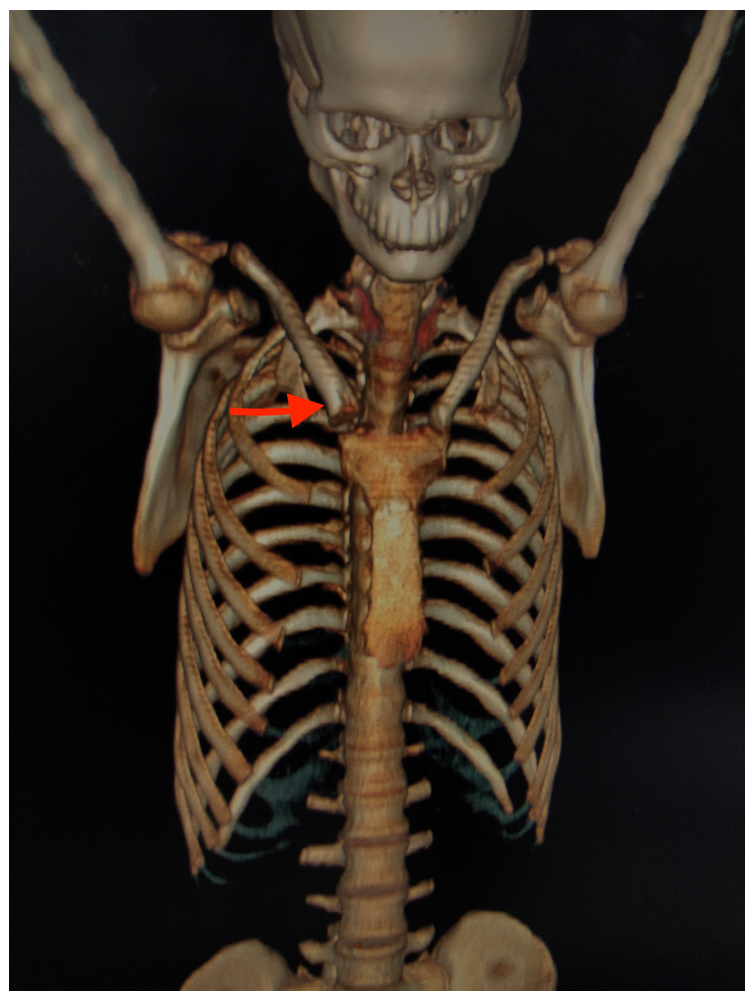 Reconstructed 3D CT image of bones of the anterior chest wall showed hyperostosis of bony and sternal end of right clavicle (red arrow).