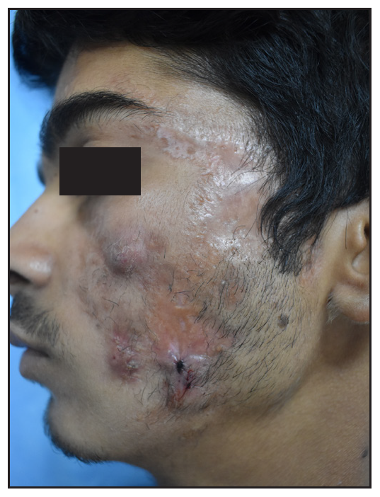 Scarring over right cheek post-treatment.