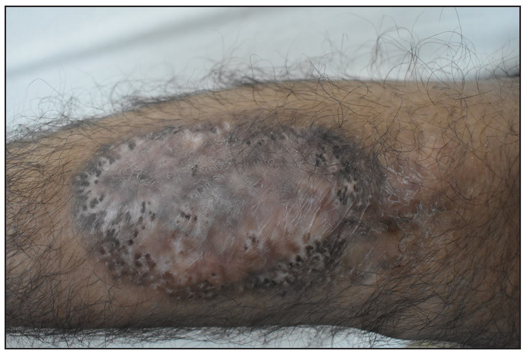 Healed ulcer with cribriform scarring over the right leg post-treatment.