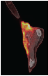 PET-CT showing FDG uptake in the skin and soft tissue around the plaque on the ankle.