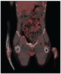 PET-CT showing common FDG uptake in common iliac lymph nodes.