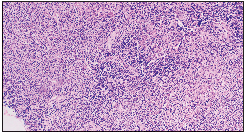 Multi-nucleate giant cells within granulomas, admixed with atypical hyperchromatic lymphocytes (Haematoxylin and eosin, 200x).