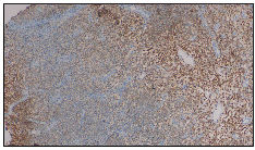 CD4 positive staining of lymphocytes (Immunohistochemistry, 100x).