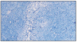 CD8 negative staining of lymphocytes (Immunohistochemistry, 200x).Granulomatous lower leg plaques