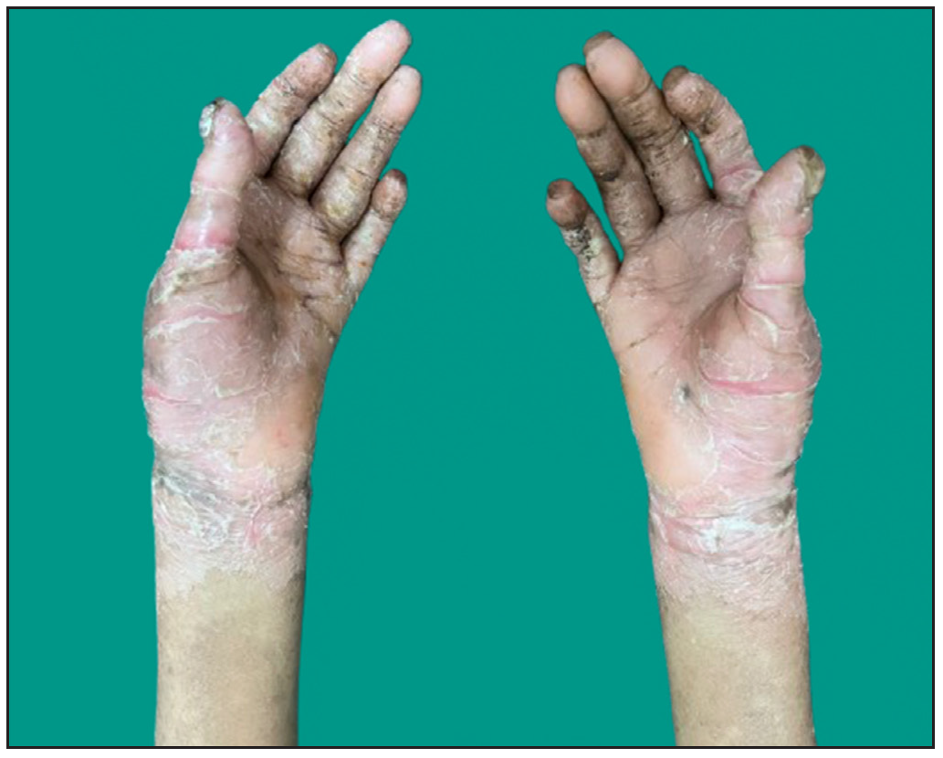 Thick hyperkeratotic plaques with deep fissures along with fixed contracture deformities involving both hands in the proband.