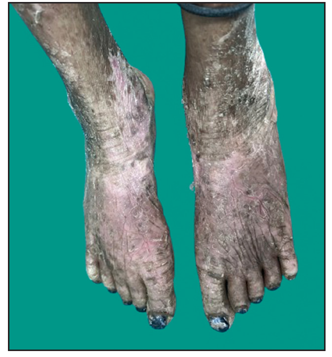 Erythematous scaly plaques on the dorsal aspect of both feet and ankles in proband.