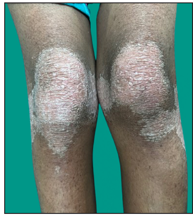 Psoriasiform plaques on the extensor aspect of both the knees in proband.