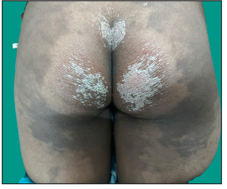 Psoriasiform plaques over the buttock region in proband.