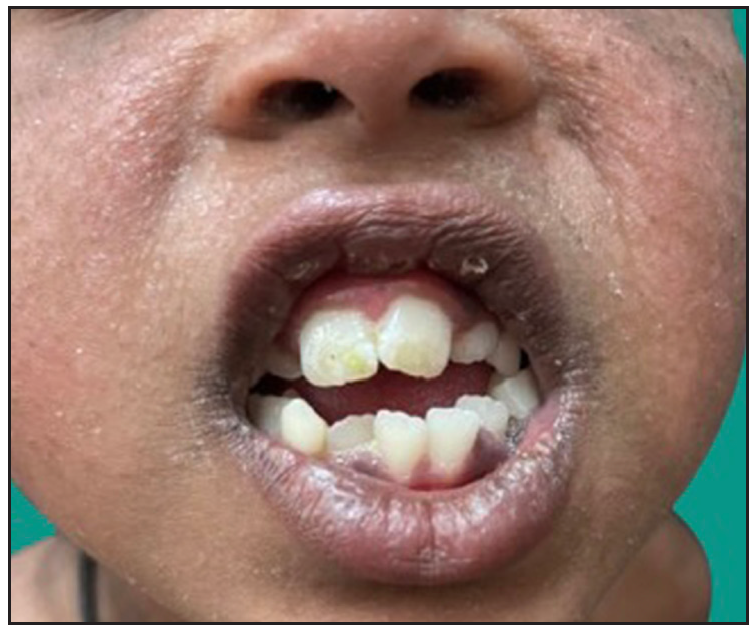 Crowded teeth, gingival hypertrophy in the younger sibling girl.Haim-Munk syndrome in an Indian consanguineous family