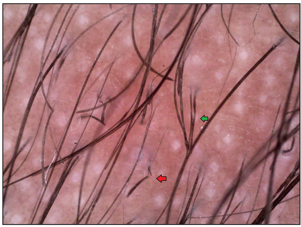 Irregularly arranged multiple nodes (green arrow) and Trichoschisis (red arrow), white dots (Dino-lite AM7115MZT, non-contact, polarised mode, 50x).