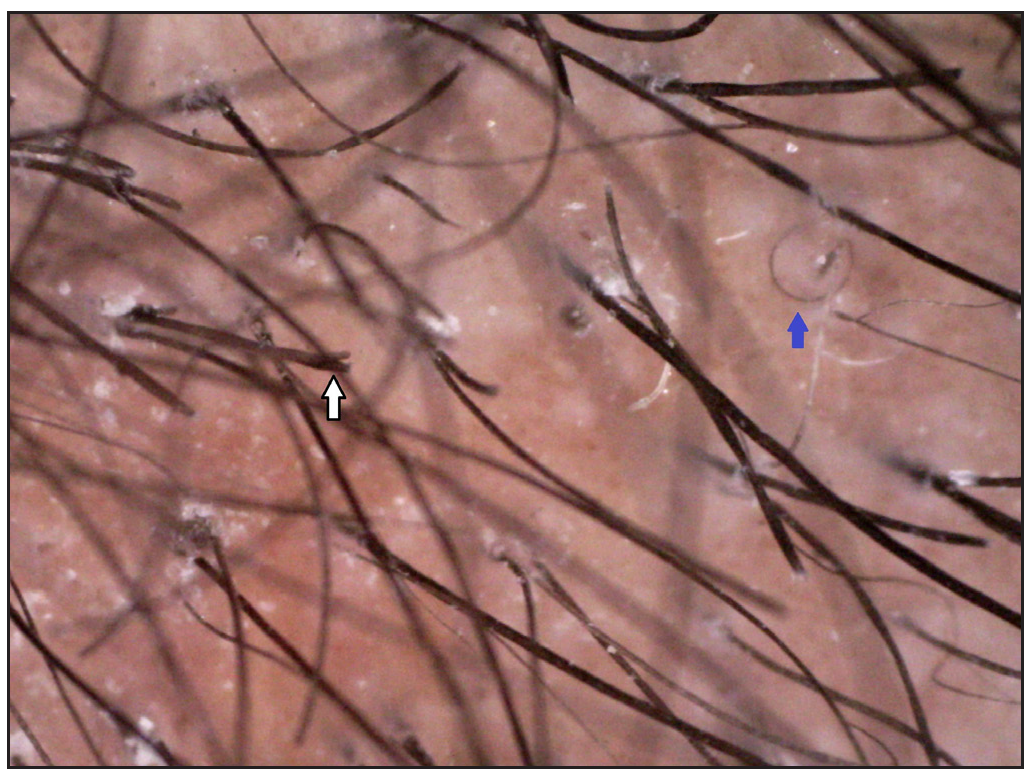 Trichoptilosis (white arrow) and coiled hair (blue arrow) (Dino-lite AM7115MZT, non-contact, polarised mode, 50x).