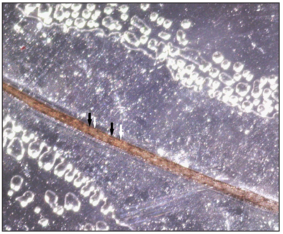 Polarised transilluminating dermoscopy showing alternate dark (black arrows) and light band (white arrows) (Dino-lite AM7115MZT, non-contact, polarised mode, 50x).