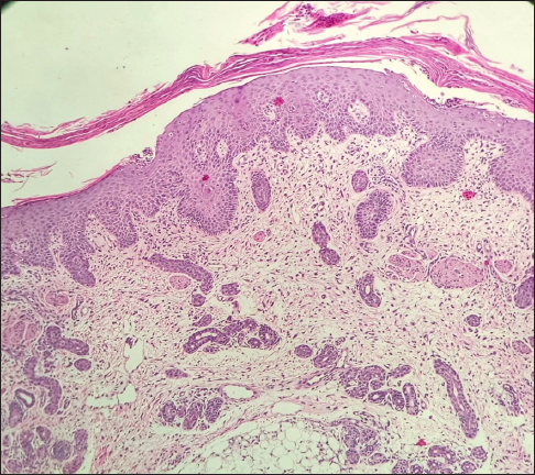 Histopathological examination (Haematoxylin & eosin, 100×) shows hyperkeratosis and irregular acanthosis of the epidermis. Dermis shows mild perivascular lymphocytic infiltrate with melanin incontinence.