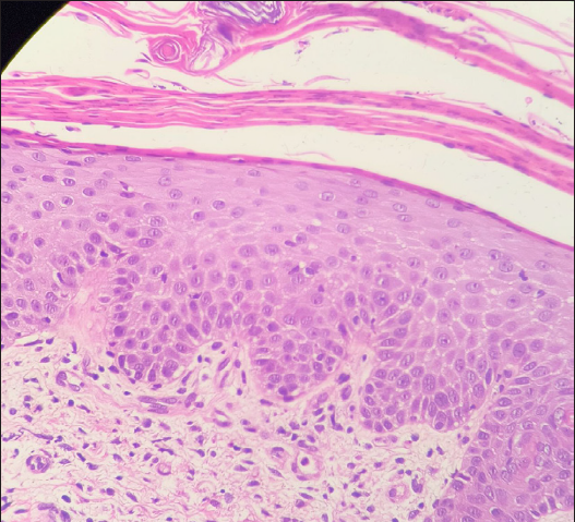 Histopathological examination (Haematoxylin & eosin, 400×) shows lamellar hyperkeratosis with parakeratosis and exocytosis of neutrophils and lymphocytes.