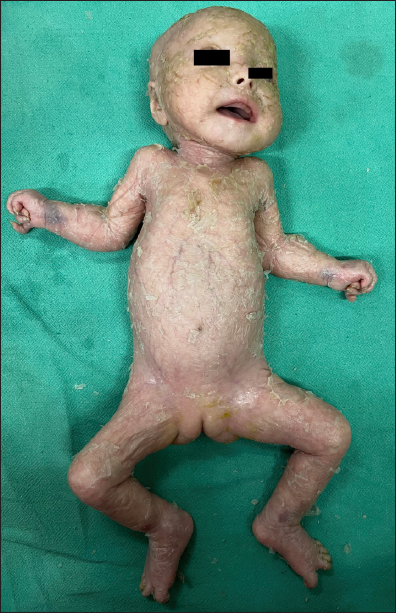 Patient 2 – Generalised lamellar ichthyosis with fissuring of skin in folds, flexion contractures of upper and lower limbs, arthrogryposis and palmoplantar keratoderma.