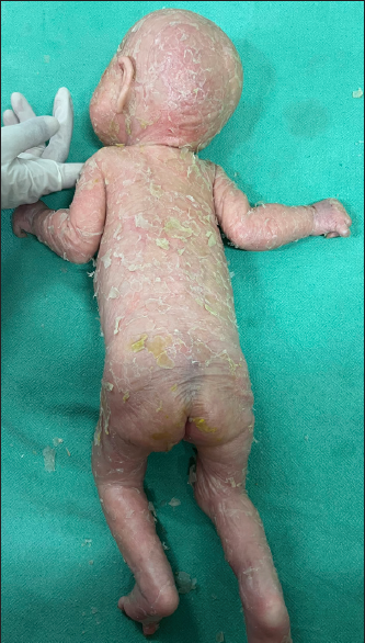 Patient 2 – ichthyotic scaling, desquamation of skin over lower limbs.