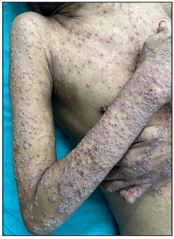 Multiple papules, crusted papules with collarette of scales.