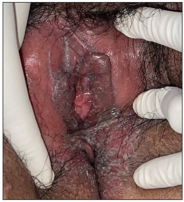 Circinate vaginitis.