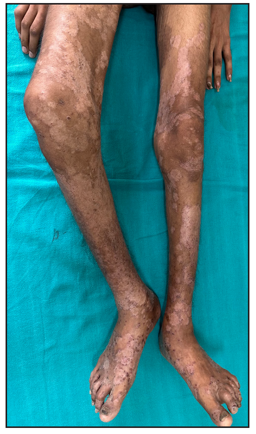 Patient with Contracture of right knee.