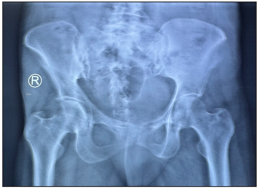 X ray Pelvis shows subchondral sclerosis with articular margin irregularity in right sacroiliac joint suggestive of sacroiliitis.