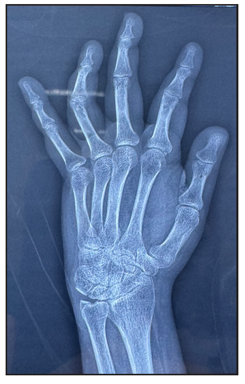 X ray of left hand shows reduced radio-carpal joint space with juxta-articular osteopenia at wrist joint, intercarpal joints, metacarpophalangeal joints and interphalangeal joints.