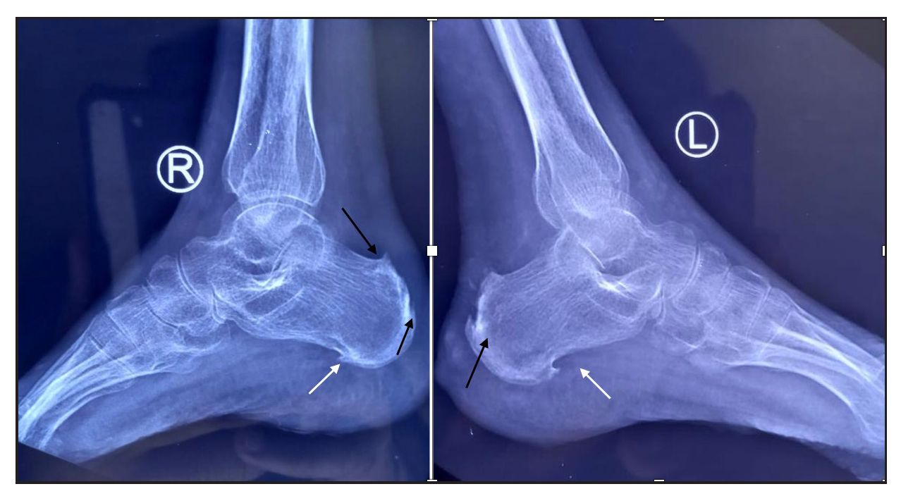 X-ray of bilateral ankle joint shows plantar calcaneal spur (white arrows) and dorsal calcaneal spur at Achilles tendon insertion (black arrow) suggestive of enthesopathy.