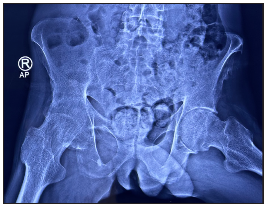 X ray of the pelvis shows irregularity of left ischial tuberosity with new bone proliferation suggestive of enthesopathy.