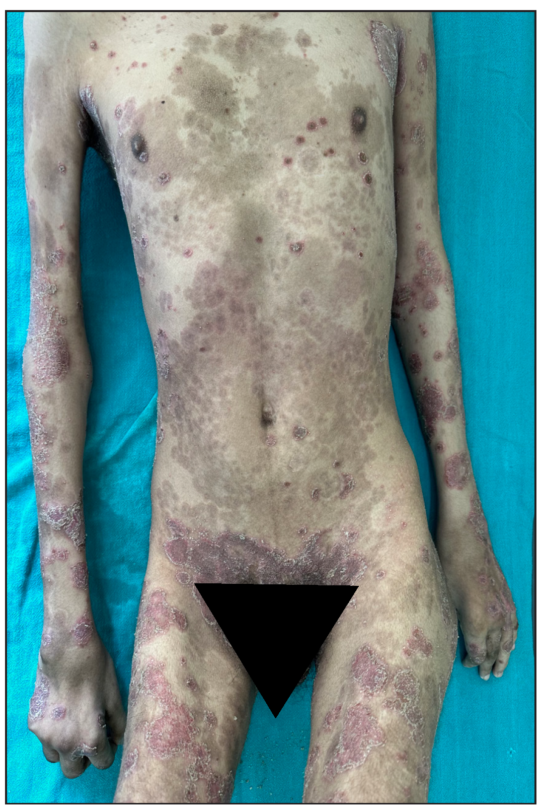 Pre-infliximab baseline picture of skin lesions loading dose.