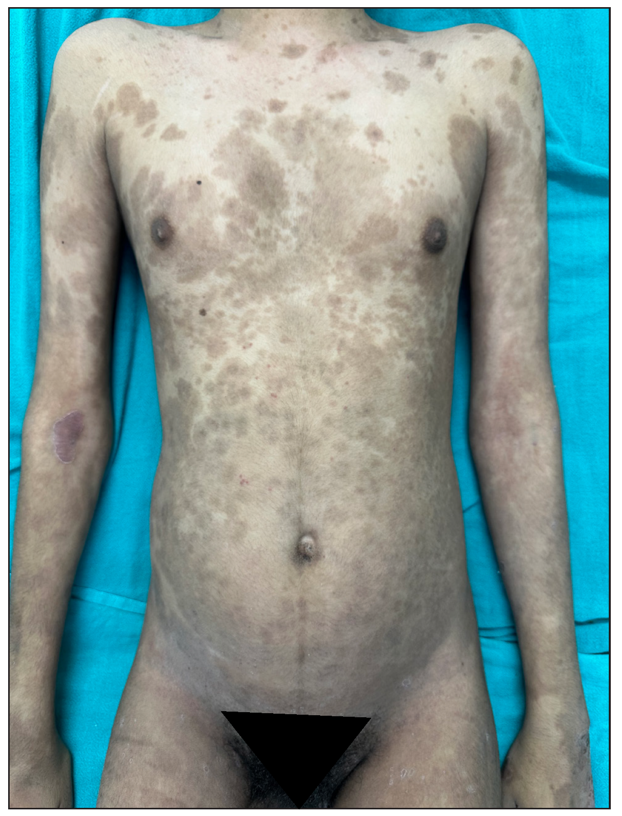 Complete improvement of skin lesions post-infliximab 8 weeks.