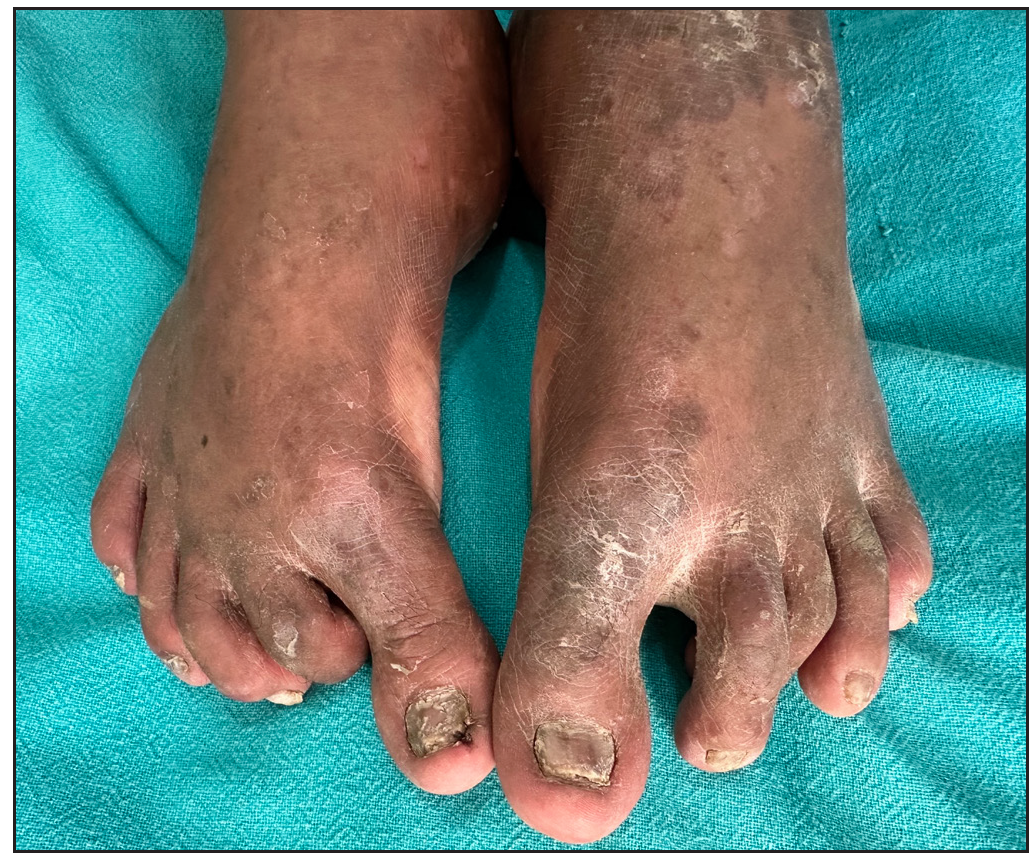 Improvement in nail dystrophy post-infliximab 5 months post treatment.