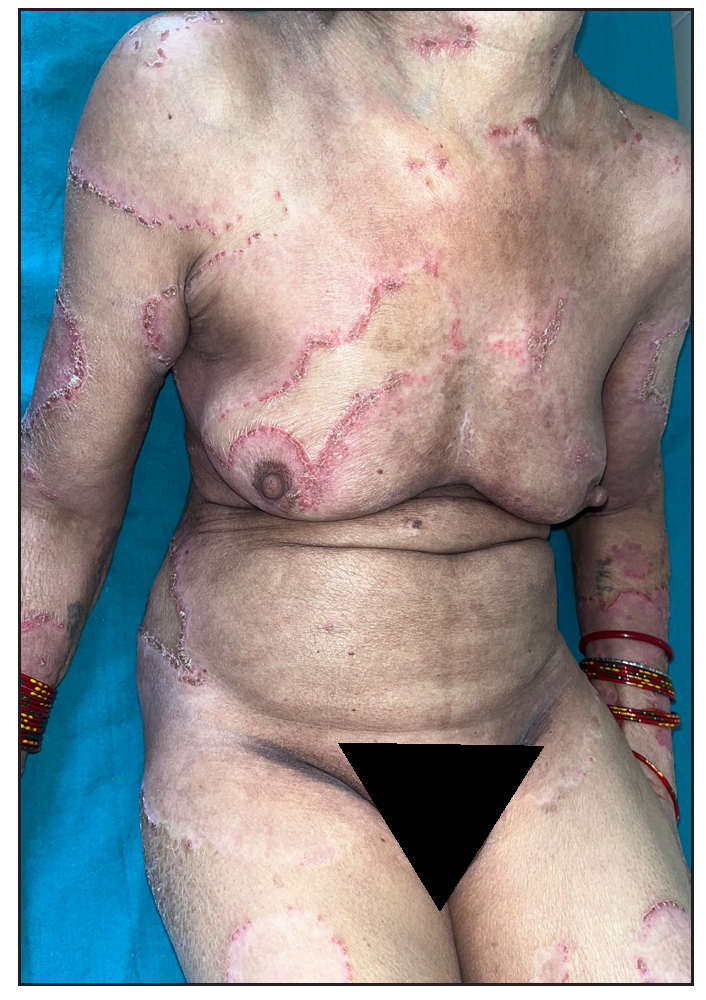 Multiple large annular plaques with crusted papules at margin in a female.